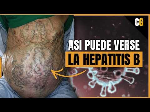 Hepatitis B: How Does It Cause Cirrhosis and Cancer? - An Underestimated Infection