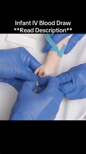 Brian “The IV Guy” on Instagram: "With kiddos we always want to do our very best to save them a poke when we can. Drawing blood with an IV start is a good way to do this. . Once the IV is in, leave the tourniquet in place and have a pedi tube ready (and a qualified assistant). Drip into the tube until the fill volume is reached, remove the tourniquet, then flush and secure your IV. (FYI, this can only be done with catheters that don’t have a blood control valve). . Learn exactly how to do this a