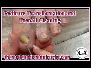 Pedicure Transformation Tutorial Deepest Ingrown Toenail or Pincer Toenail