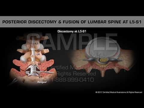 Posterior Discectomy & Fusion of Lumbar Spine at L5-S1