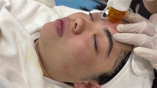 Rf micro needling #rfmicroneedlingtreatment