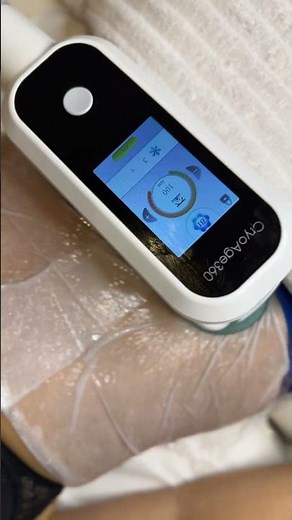 Comment fonctionne la cryolipolyse ?