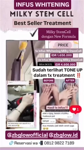 𝗪𝗛𝗜𝗧𝗘𝗡𝗜𝗡𝗚 | 𝗦𝗟𝗜𝗠𝗠𝗜𝗡𝗚 | 𝗦𝗞𝗜𝗡 𝗕𝗢𝗢𝗦𝗧𝗘𝗥 | 𝗛𝗘𝗔𝗟𝗧𝗛𝗖𝗔𝗥𝗘 | 𝗠𝗨𝗟𝗧𝗜𝗩𝗜𝗧𝗔𝗠𝗜𝗡 on Instagram: "BEST SELLER TREATMENT! 😍 Infus Whitening Milky Stem Cell memiliki banyak manfaat untuk kulit dan tubuh kamu, serta 10x LEBIH CEPAT mencerahkan sebening susu. Pembelian paket bisa dicicil, lho! ✨🫶🏻 Tunggu apalagi? Segera reservasi sekarang juga! 🥰 ✅ Dilakukan oleh tenaga medis profesional yang sudah tersertifikasi nasional maupun internasional. ✅ Bisa homecare Surab