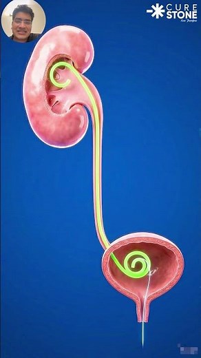 Why Doctors Leave a WIRE Inside Your Kidney?! 😱 (DJ Stent Truth Revealed)