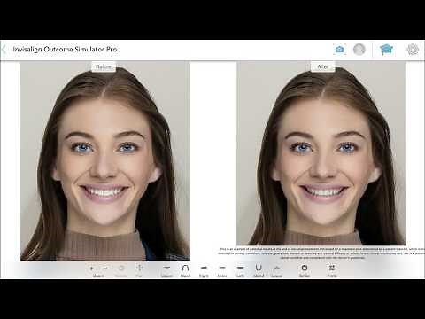 Realistic smile visuals with Invisalign® Outcome Simulator Pro