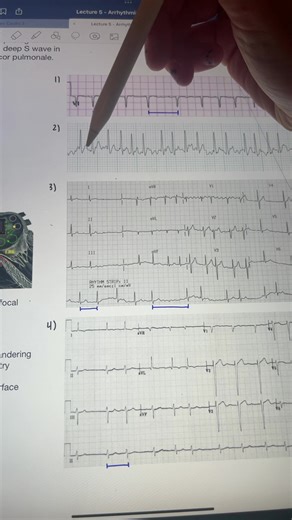 Understanding ECG Basics: Multiple Re-entry Circuits Explained
