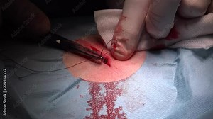 Surgical suture commonly called stitches is a medical device used to hold body tissues together after an injury or surgery.