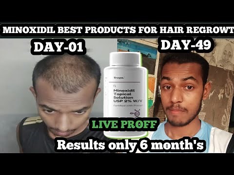 Minoxidil Hair Regrowth Results | Before & After Journey