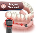 Magnetic Implants - FMS DENTAL HOSPITAL