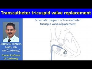 Transcatheter tricuspid valve replacement