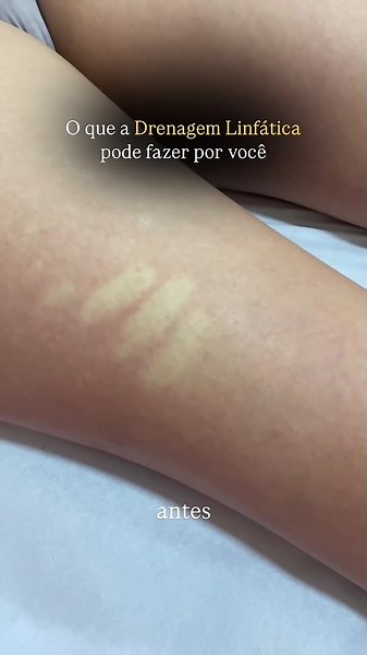 Drenagem Linfática: Benefícios para Seu Bem-Estar