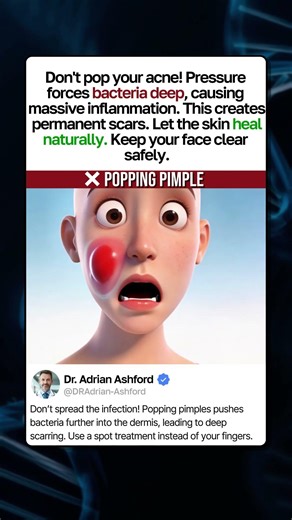 Why You Must STOP Popping Pimples! #facts #health #beauty #acne