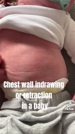 Retractions in baby | Fast breathing | Chest retractions