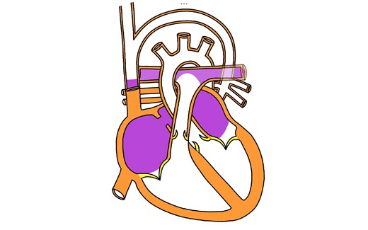 Total Anomalous Pulmonary Venous Drainage (TAPVD)