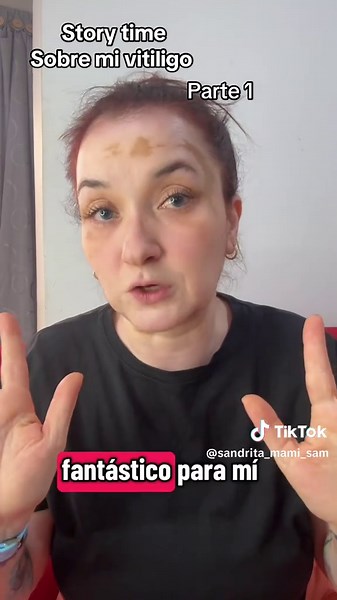 Historia sobre el vitiligo: Parte 1