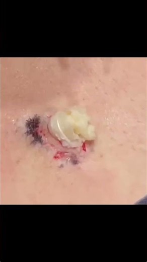 Dermatologist Removes Stubborn Chest Mass
