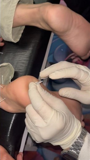 Dry Needling for Heel Pain | Plantar Fasciitis & Heel Spur Relief