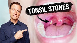 61K views · 1.3K reactions | Find out how to prevent tonsil stones...