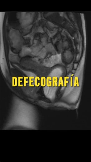 Dr. Jonah Serrano | Radiología on Instagram: "¿Conocías este estudio de radiologia? Fuente : Revels JW. MR Defecating Proctography with Emphasis on Posterior Compartment Disorders. RadioGraphics. 2023 #radiology #salud #estudiantedemedicina #rayosx #educaciónmédica #mri #imaging #radiologia #fisiología"