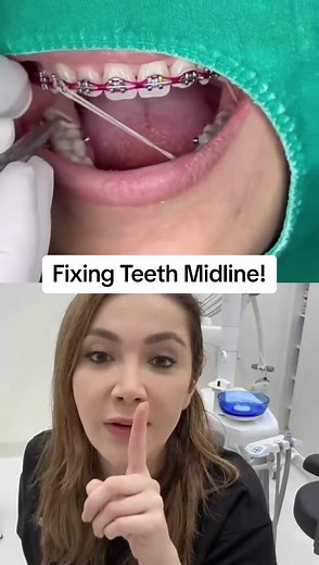 How Do dentist fix your teeth midline?!#midline #midlineshift | teeth