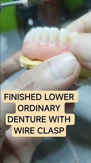 # denture,#wire clasp