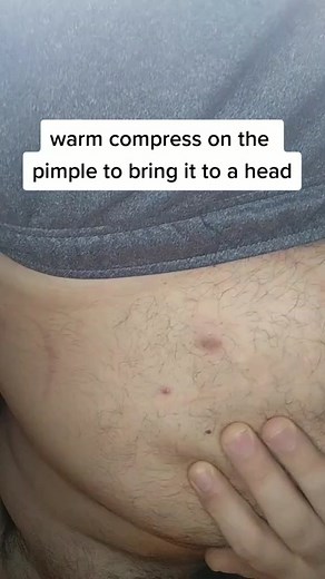 Warm compress on the pimple always! #pimple #pimples #pimplepop #dermdoctor #boil #boilpopping #2022 #thatsbombtv #fyp #foryou #foryoupage #fypシ #fy