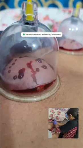Hijama Session For poor Circulation