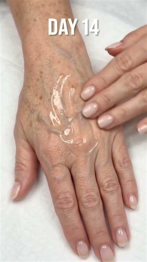 Dark age spots & thin crepey hand skin visibly restored by Day 60! 🇺🇸 Formulated and shipped in