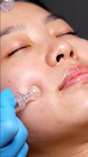 “Extreme Close-Up Blackhead Removal That Will Shock You!”