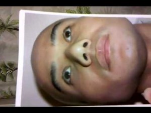 Part 1 Asian Rhinoplasty Male Patient (Before Photos)