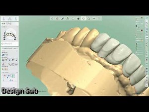 3shape design (implant case, anterior teeth 😬 😁 😀 6 unit's)