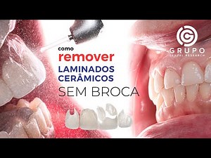 🦷 Conservative Removal of Ceramic Veneers/Lenses with Er:YAG Laser | Clinical Tutorial
