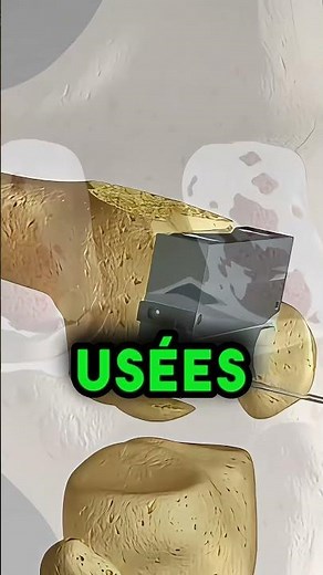 Ce qui se passe pendant une opération de prothèse du genou! #bienetre #conseilssante #santé #genou