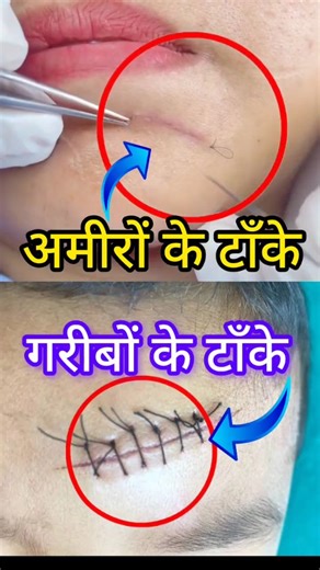 Satish Patel on Instagram: "Surgical suture Stitches OT knowledge Hospital emergency #doctor #health #healthtips #trendingreels #hospital #nursing #trend"