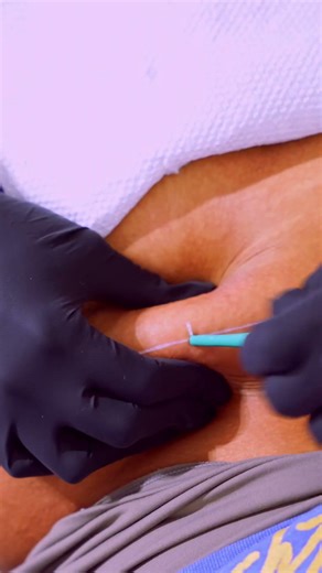 Perfect Back Dermal Piercings