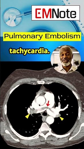 Pulmonary Embolism (PE)