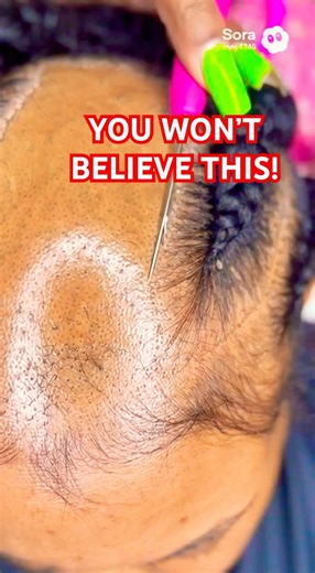 This alopecia technique changes EVERYTHING! #alopecia #protectivestyles #hairtransformation