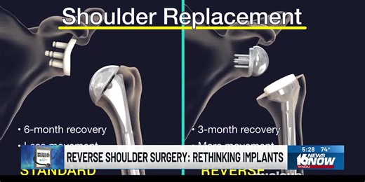 Medical Moment: Reverse shoulder replacement surgery