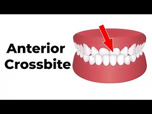 Easy Anterior Crossbite Correction for Pediatric Dentists in a Early Mixed Dentition Patient