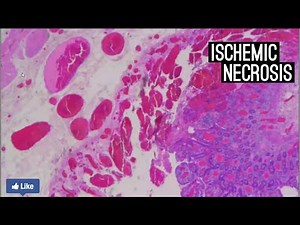 Ischemic Necrosis