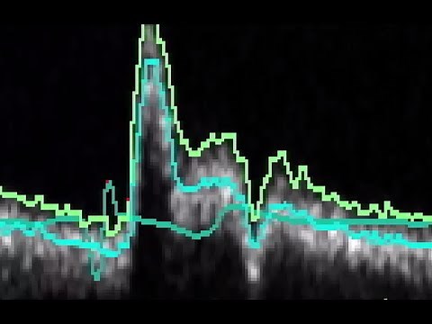 Pulse Wave Velocity Analysis From Ultrasound Images