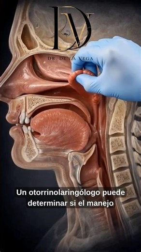 This is what adenoids look like when they obstruct airflow #ENT #sinusitis #medicine