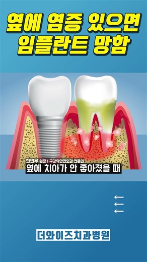 The Hidden Conditions of 10-Year-Old Implants...#DentalDiagnosis #ImplantSurgery #Periodontitis