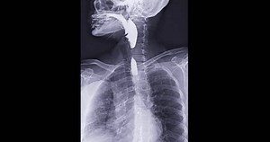 Флюороскопия результатов пробы с барием, показывающая: стоковое видео (без лицензионных платежей), 3833050739 | Shutterstock