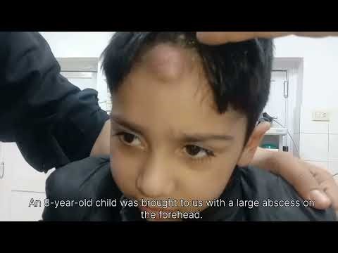 Painful Forehead Abscess Treated Successfully | Pediatric Case | I&D Procedure | #general anesthesia