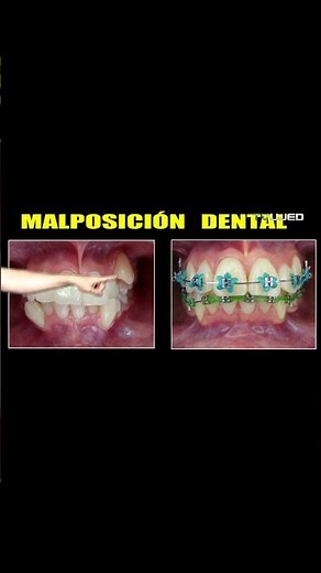 Braces Transformation! (Before / After)