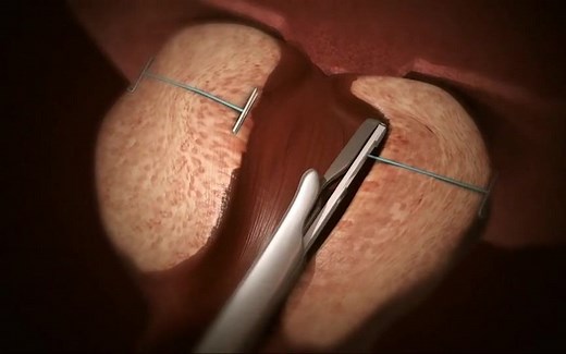 UroLift治疗良性前列腺增生(BPH)手术过程演示