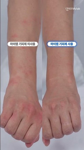 [해충전문가 세스코가 만든 모기 기피제] 모기로부터 나만 투명인간 되는 법! #세스코 #모기 #모기기피 #진드기 #모기기피제 #세스코모기기피제 #세스코마이랩 #모기투명인간