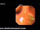 Endoscopic Indicators of Esophageal Achalasia • Video • MEDtube.net