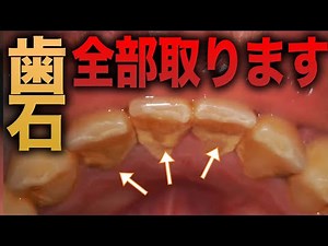 【歯石除去全部見せます】90秒で歯石が取りたくなる動画